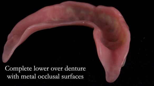 Newsletter 44 - extreme removable prosthodontics – engineering a super-strong and ultra-thin over denture