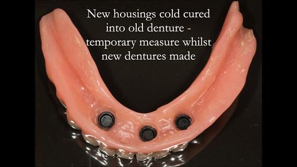 New housings cold cured into old denture - temporary measure whilst new dentures made - this made the fit of the existing denture more comfortable