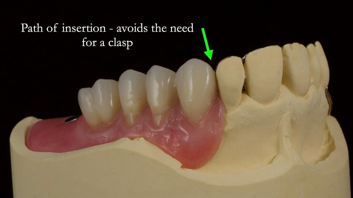 Newsletter 89 – Simon: A Challenging Kennedy Class II Division 1 Upper CoCr Partial Denture with a High Smile Line