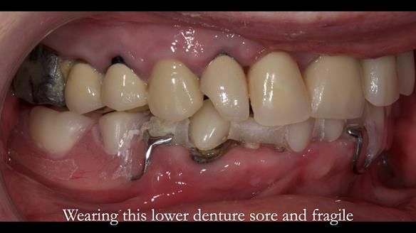 Newsletter 44 - extreme removable prosthodontics – engineering a super-strong and ultra-thin over denture