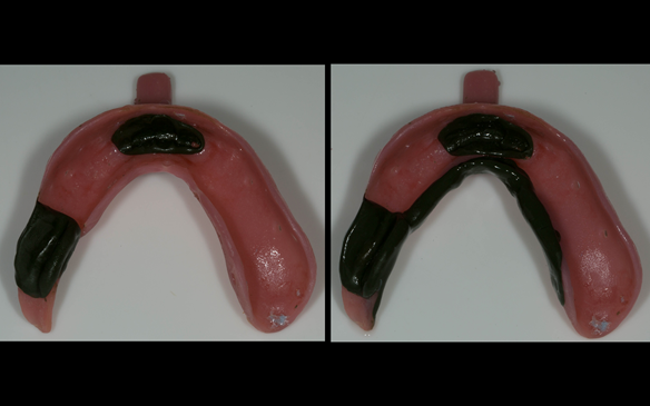 Fig 55 Greenstick compound stops are placed on the fitting surface of the custom tray to ensure repeatable positioning of the tray. Border moulded greenstick compound on the custom tray ready for the working impression in alginate.