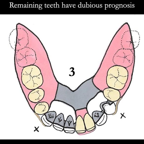 Universal Scandinavian partial denture designs