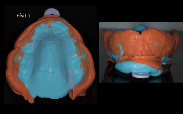Figure 63 Maxillary primary impression made in two stages using Accudent XD, Ivoclar. This allows full extension to record the sulcui