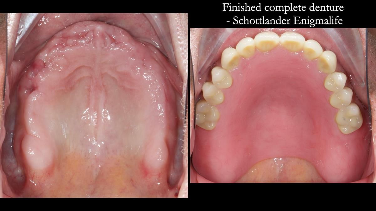 Fin’s Newsletter 88 — Complete dentures - full protocol… he rearranged his own teeth!