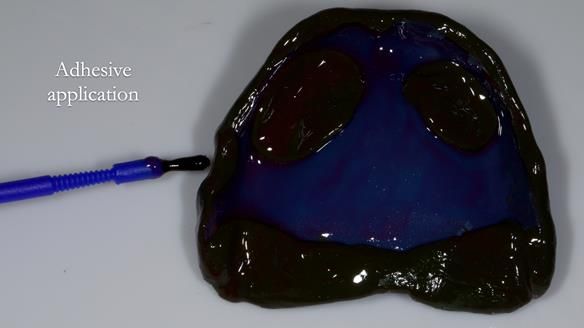 Newsletter 83: Sheila’s Complete Denture Success