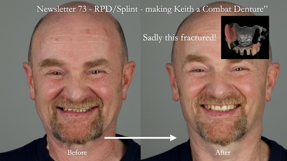 Newsletter 81 - Pam’s Story — how a partial denture changed her life (+ live walkthrough this Thursday)