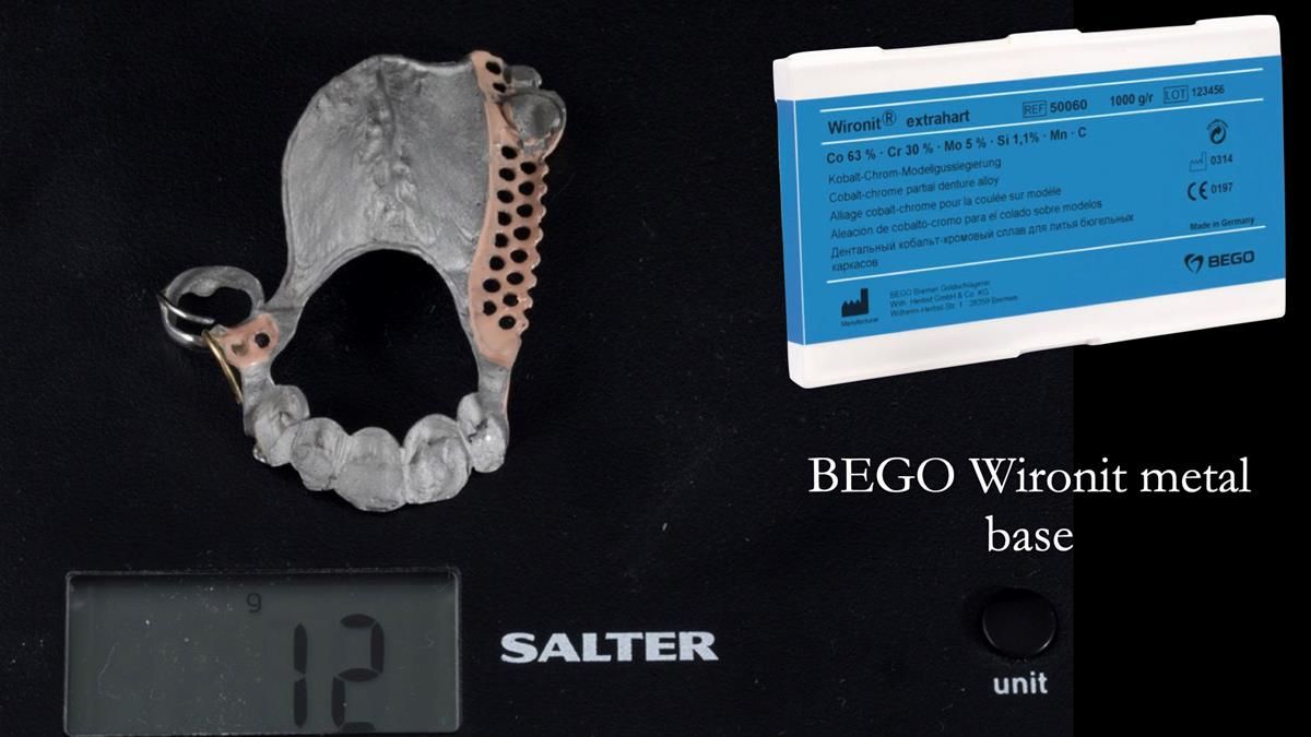 Newsletter 89 – Simon: A Challenging Kennedy Class II Division 1 Upper CoCr Partial Denture with a High Smile Line