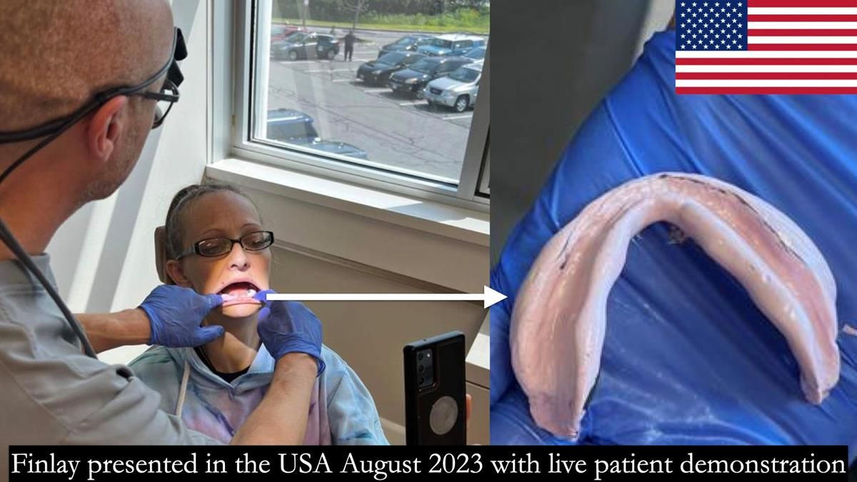 Finlay's Newsletter 59 Ultra hard partial dentures made for Gill