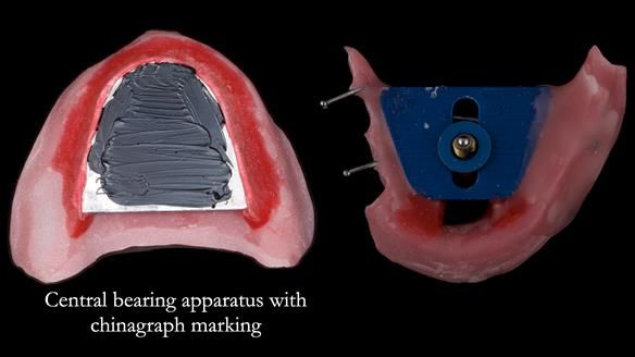 Newsletter 82 Mary - A complete upper and a one-tooth gasket denture