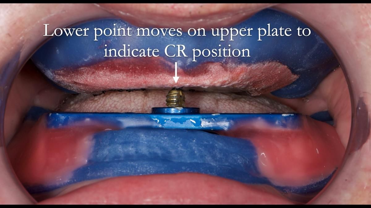 Fin’s Newsletter 88 — Complete dentures - full protocol… he rearranged his own teeth!