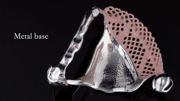 Upper metal base partial denture/occlusal stabilisation splint/obturator - full protocol