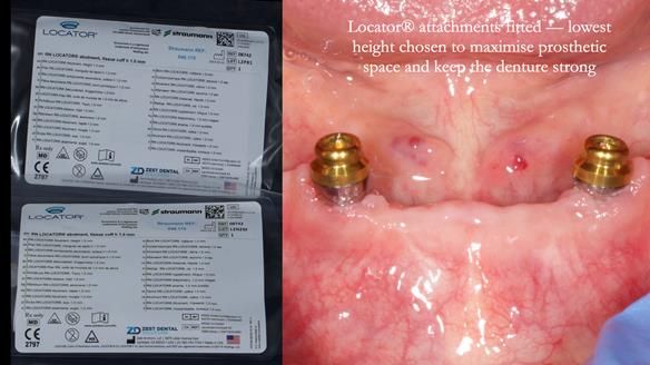 Newsletter 78: What do Clark Gable and a Locator® overdenture have in common?