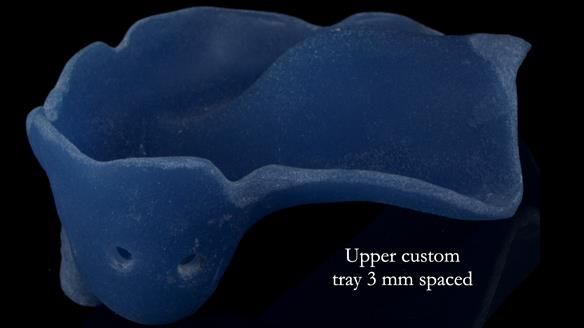 Newsletter 55 Provision of metal based partial dentures for Zephyrine with a repaired cleft lip and palate