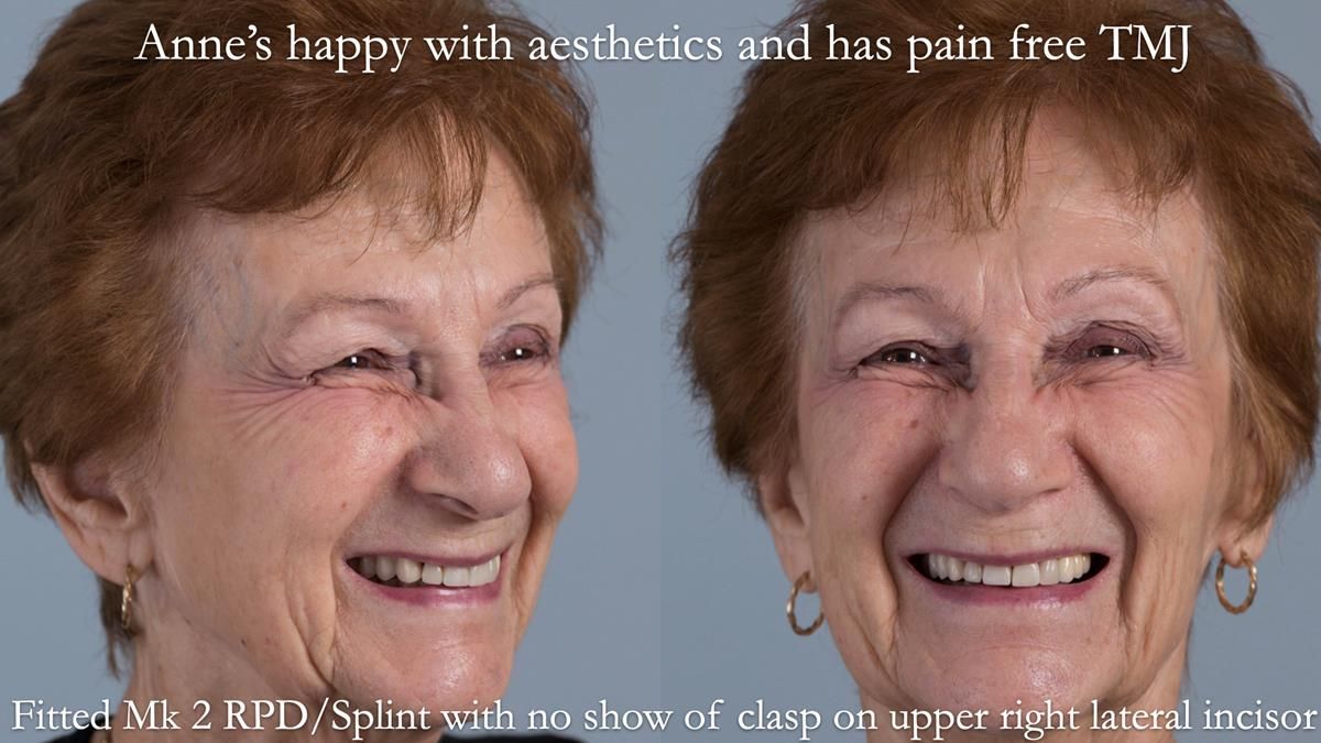 Newsletter 51 Managing Anne’s failing dentition with distal extension base RPD/Splint FULL PROTOCOL