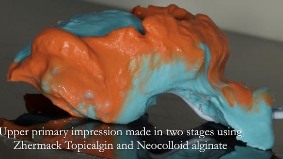 Complete denture Class II div 2 deep overbite Newsletter 39