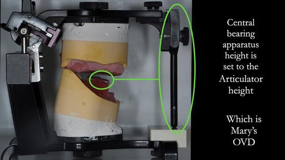 The central bearing apparatus is set to the same occlusal vertical dimension as the carved wax rims, by opening or closing the screw on its lower part. This sets the vertical dimension of the central bearing apparatus to Mary’s OVD. Therefore the gothic a