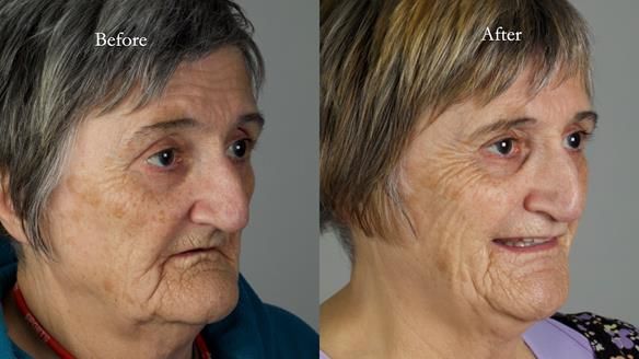 Newsletter 83: Sheila’s Complete Denture Success