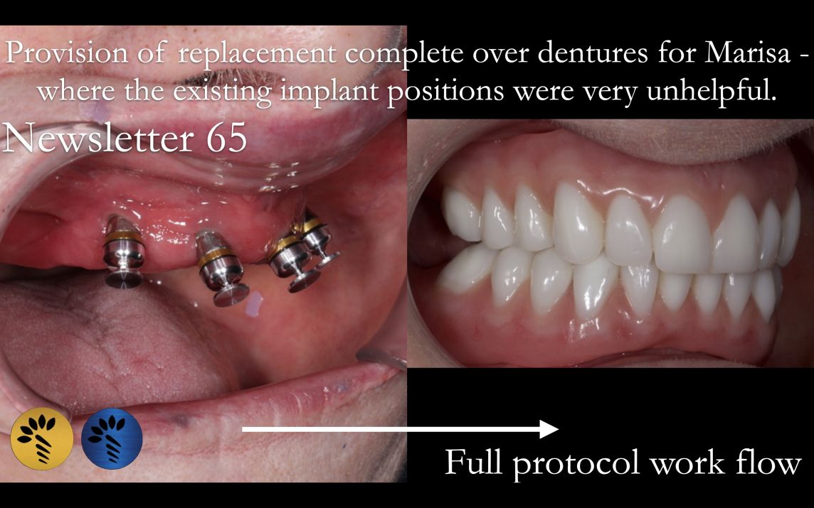 Finlay's Study Club Live 1 Managing a patient with overdentures on badly positioned implants