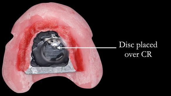Complete denture Class II div 2 deep overbite Newsletter 39
