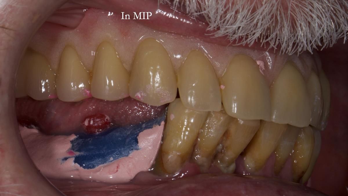 Newsletter 87 – Father Peter: A Partial Denture that needed Minor Miracle