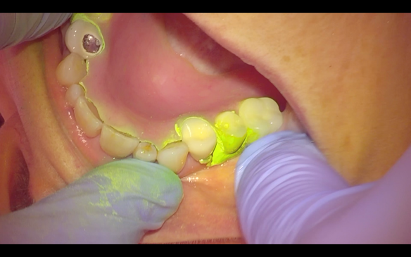 Figure 32 Seating the immediate denture to check the fit with light bodied silicone and Occlude spray