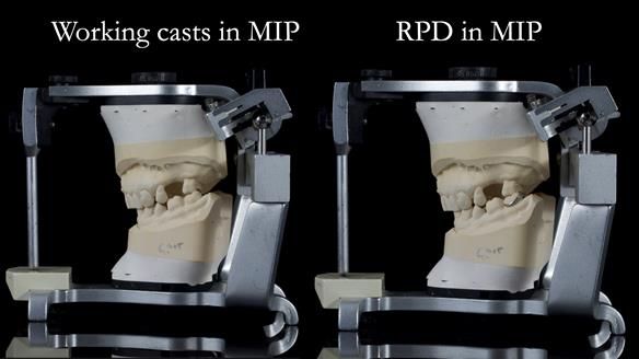 Finlay's Newsletter 61 provision of a lower unilateral free end saddle metal based partial denture for Joyce