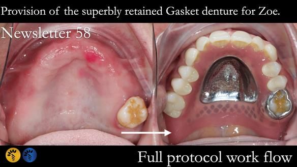 Finlay's Newsletter 58 Gasket upper partial denture for Zoe