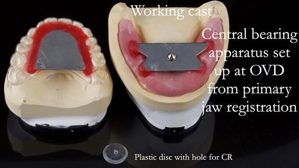 Newsletter 44 - extreme removable prosthodontics – engineering a super-strong and ultra-thin over denture