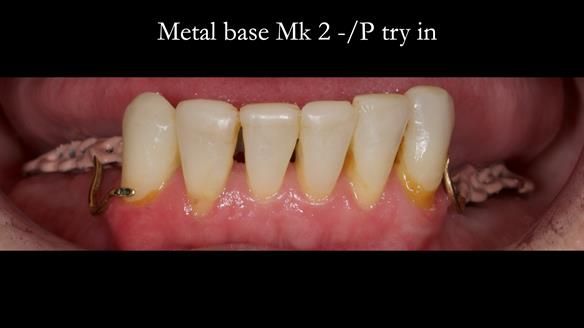 Newsletter 52 Managing Jo’s failing dentition with extractions and Mk 1/Mk 2 complete upper dentures and lower partial dentures FULL PROTOCOL