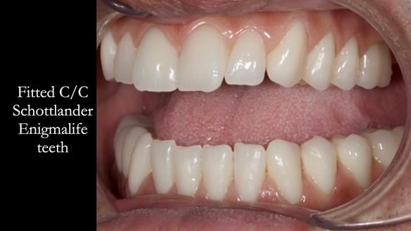 Managing poor implant positioning with complete dentures and Locator attachments - full protocol Newsletter 41