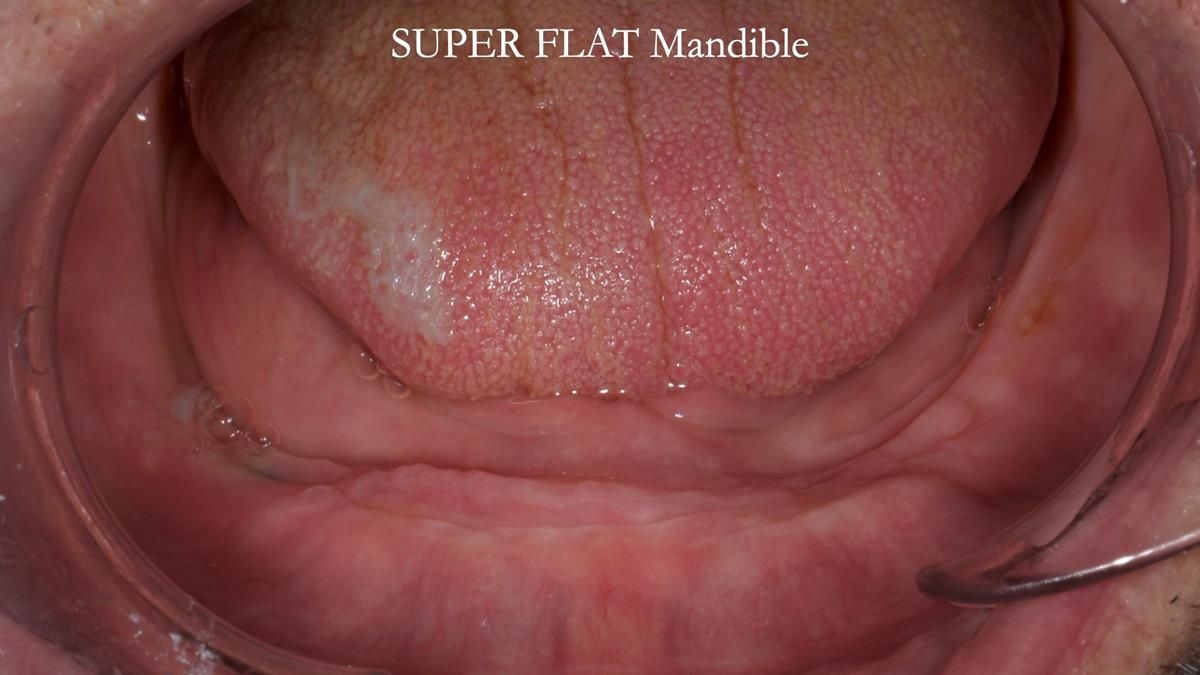 Fin’s Newsletter 88 — Complete dentures - full protocol… he rearranged his own teeth!