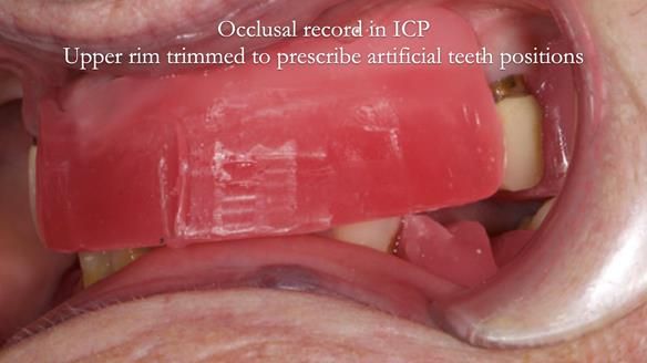 Eileen's transformation with upper and lower RPDs of Scandinavian hygienic design FULL PROTOCOL