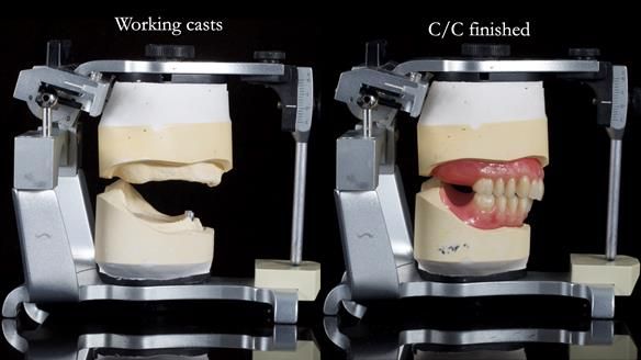 Newsletter 78: What do Clark Gable and a Locator® overdenture have in common?