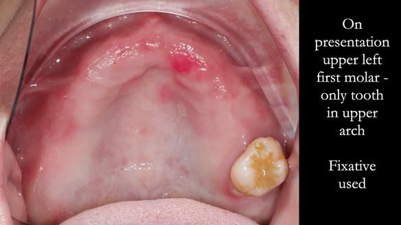 Finlay's Newsletter 58 Gasket upper partial denture for Zoe