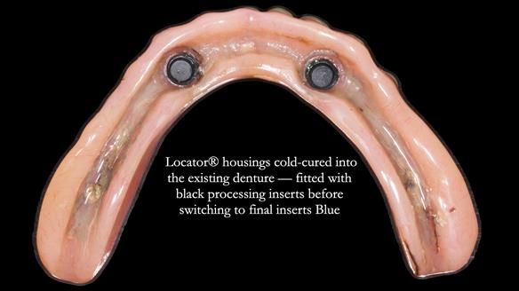 Newsletter 78: What do Clark Gable and a Locator® overdenture have in common?