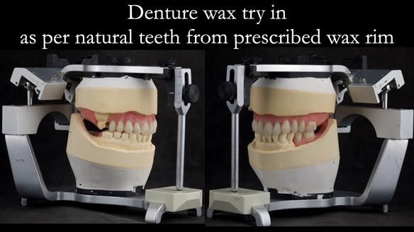 Newsletter 52 Managing Jo’s failing dentition with extractions and Mk 1/Mk 2 complete upper dentures and lower partial dentures FULL PROTOCOL