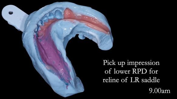 Newsletter 52 Managing Jo’s failing dentition with extractions and Mk 1/Mk 2 complete upper dentures and lower partial dentures FULL PROTOCOL
