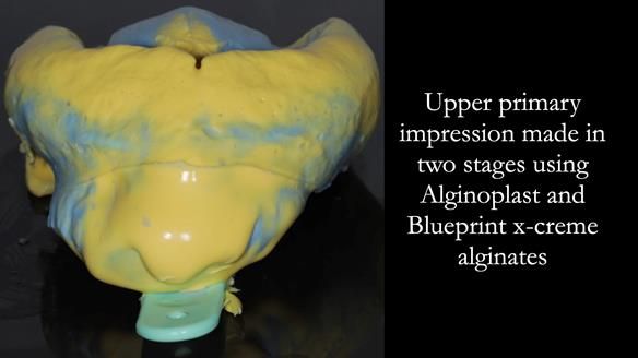Finlay's Newsletter 59 Ultra hard partial dentures made for Gill
