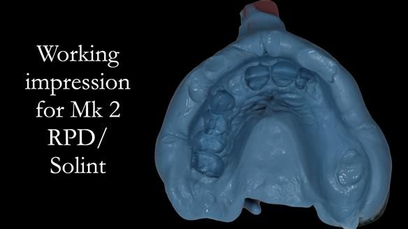 Newsletter 51 Managing Anne’s failing dentition with distal extension base RPD/Splint FULL PROTOCOL
