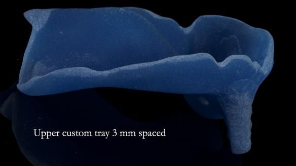 Newsletter 55 Provision of metal based partial dentures for Zephyrine with a repaired cleft lip and palate