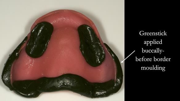 Greenstick is then applied to the borders of the tray from the 4s back to the tuberosities - this enhances suction/retention. This is placed in the patient’s mouth with muscle trimming and the patient is instructed to move the jaws from right to left “wa