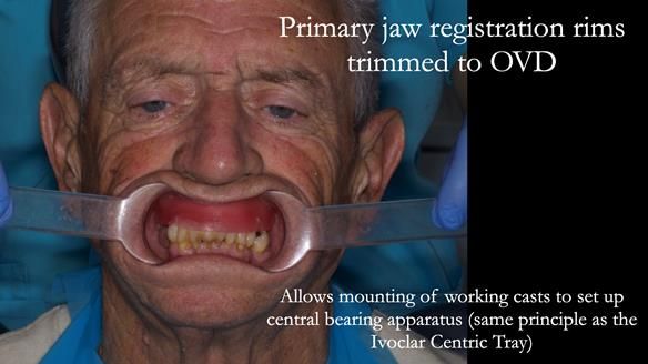 Newsletter 54 case presentation upper complete denture and lower Scandinavian designed hygienic partial denture for David