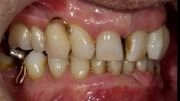 Newsletter 86 Peter the Architect — precision removable partial dentures case study