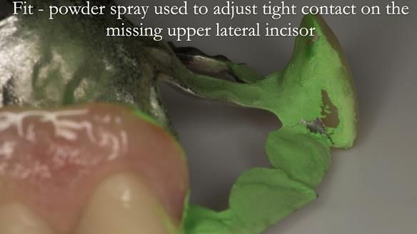 Newsletter 51 Managing Anne’s failing dentition with distal extension base RPD/Splint FULL PROTOCOL