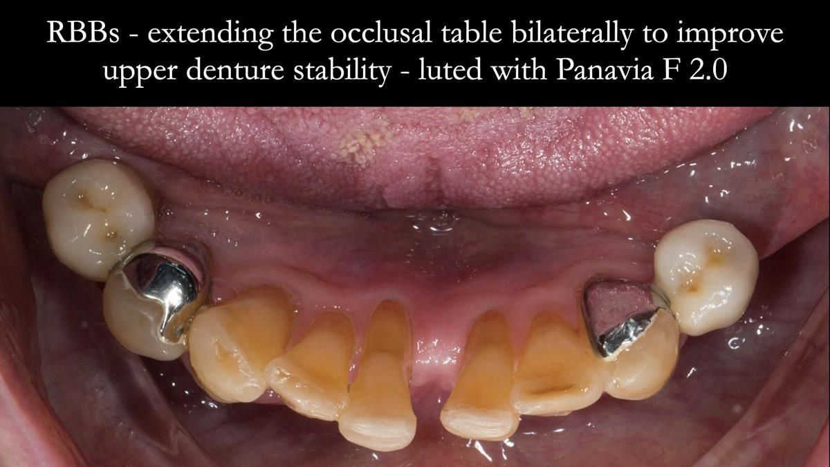 Newsletter 87 – Father Peter: A Partial Denture that needed Minor Miracle