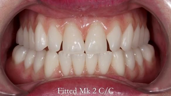 Replacing Madeline’s Complete denture FULL PROTOCOL