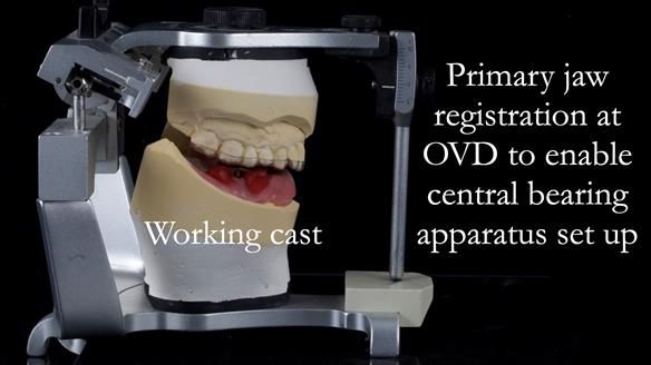 Newsletter 44 - extreme removable prosthodontics – engineering a super-strong and ultra-thin over denture