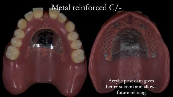 Newsletter 53 showing the making and fitting of ultra life-like dentures for Valena