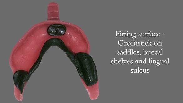 Newsletter 52 Managing Jo’s failing dentition with extractions and Mk 1/Mk 2 complete upper dentures and lower partial dentures FULL PROTOCOL