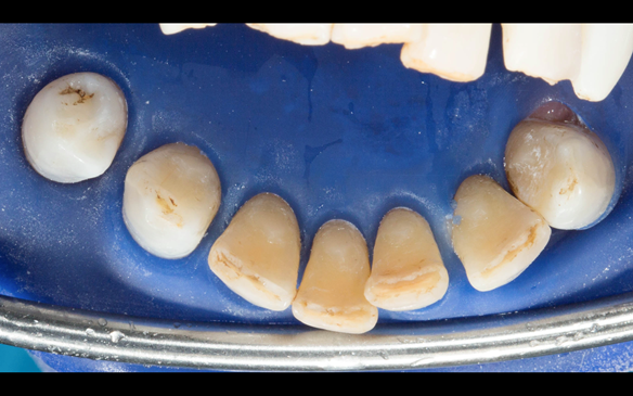 Figure 68 Composites after shaping with diamond bur on the lingual of the lower anterior teeth to assist in stabilising and supporting the Mk 2 metal based lower denture